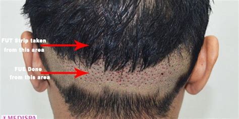 Hair Transplant Techniques .